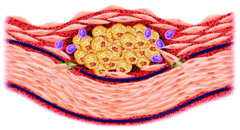 inflammation-and-atherosclerosis